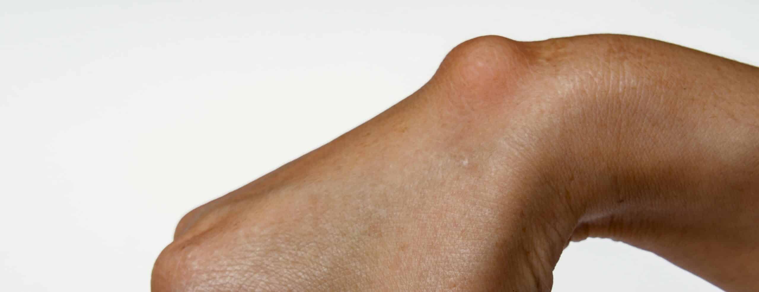 Lipome et kyste : quelles différences&nbsp;?