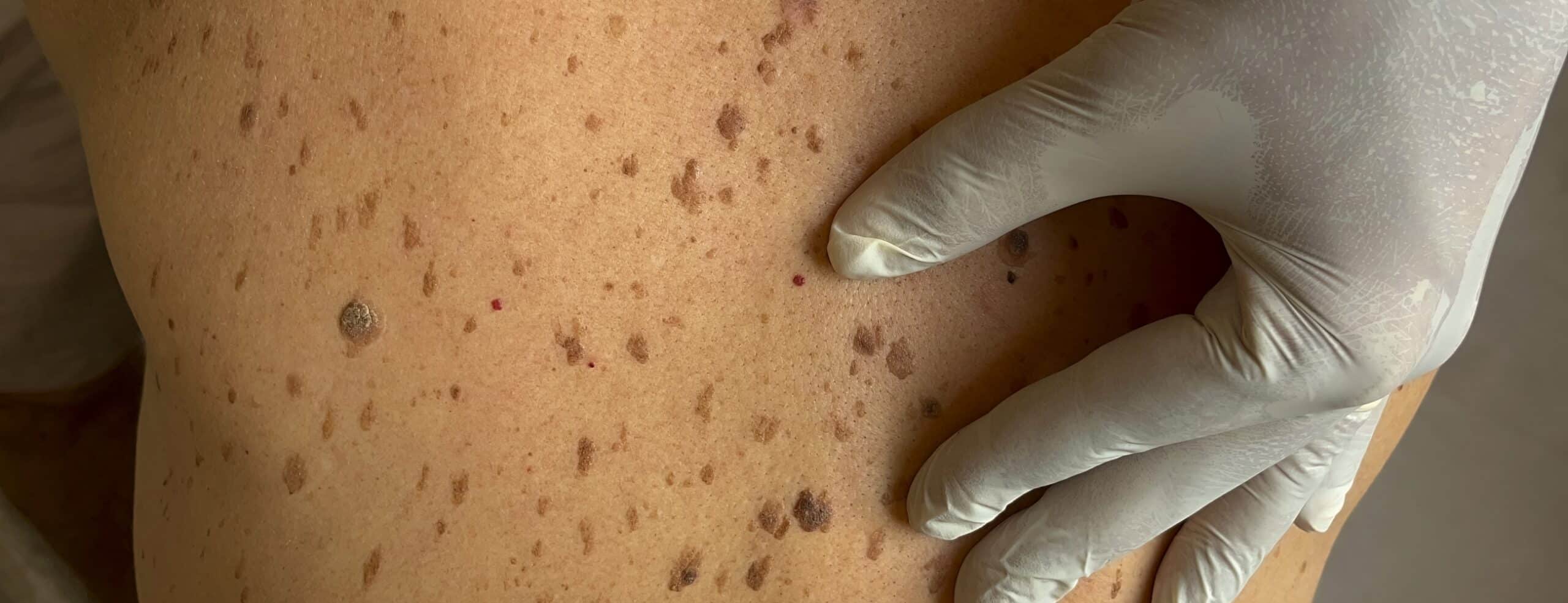 Quels sont les avantages du fotofinder&nbsp;?